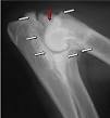 Elbow dysplasia - Wikipedia, the free encyclopedia