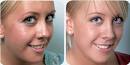  A Look at Laser Acne Treatment