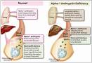 <b>Alpha</b>-<b>1 antitrypsin</b> deficiency