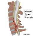 Cervical Spinal Stenosis