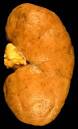 lupus <b>nephritis</b>