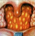 4 Causes For Having White Patches On Throat