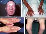 Inflammatory <b>muscle diseases</b>
