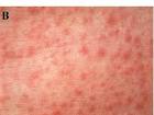 Images related to Rash 