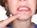  Best Over the Counter Acne Treatment