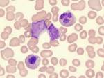 <b>myelodysplastic</b>-<b>syndrome</b>-