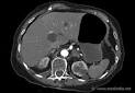 <b>Leriche Syndrome</b>