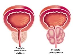 Znalezione obrazy dla zapytania prostata zdjęcia