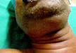 <b>Ludwig's angina</b> - Wikipedia, the free encyclopedia