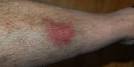 ZhurnalyWiki  Snowshoe Shin Bruise