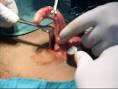 File:Inflamed appendix.jpg - Wikipedia, the free encyclopedia