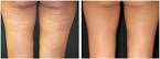 Revitol Cellulite Solution Reviews Revitol    Cellulite Solution