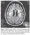 <b>Paraparesia espástica</b>