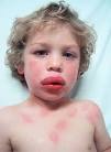 form of allergic reaction,