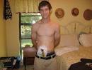 Photos 1: Colectomy « UC to J-Pouch Story