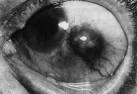 of <b>scleral disease</b>.