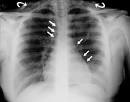 ,<b>mediastinal emphysema</b>
