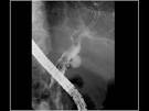 The patient had <b>hemobilia</b>.