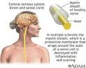 Low sunlight with glandular fever raises multiple sclerosis risk