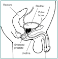 Prostate Enlargement: Benign Prostatic Hyperplasia - National ...