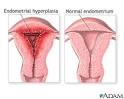 Abnormal menstrual periods - Menstrual periods - heavy, prolonged ...