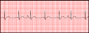 <b>premature atrial complexes</b>