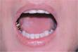 <b>Scleroderma</b>.