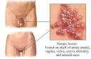  3 Ideas to Pick the right Candidiasis Supplement