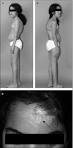Ehlers-Danlos syndrome, type VI