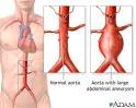 Abdominal mass - Scripps Health - San Diego