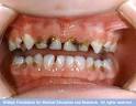 Dangers of Decay « Water Fluoridation