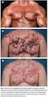  Severe Acne Treatment