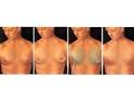 Male Breast Fat Suction (Gynecomastia) - TeamHoliday