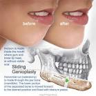 Chin Augmentation Abroad | Prague