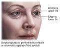 Eyelid strips – Eye Secrets eyelid lift tape