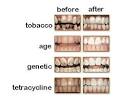 white teeth