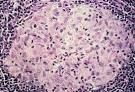 <b>granuloma</b>.