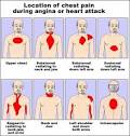 New ESC Guidelines Recommend Efient