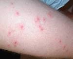 Eoncephilic <b>Folliculitis</b>