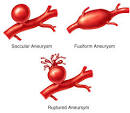 Cerebral (Brain) Aneurysms: Center for Endovascular Surgery