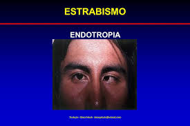 Tradução:- Elena Gelado (elenagelado@hotmail.com) ESTRABISMO ENDOTROPIA - slide_23