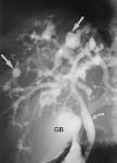 of <b>Caroli disease</b>.