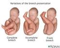 Labor and delivery - Breech - Series