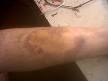 Bruises from a ladder fall