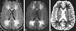 Phenylketonuria
