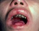 epidermolysis bullosa