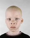 ALBINO africans - Sharenator.