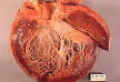 Cardiomyopathy - Wikipedia, the free encyclopedia