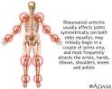 <b>Rheumatoid arthritis</b> is an