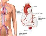 Termo-coronário-<b>angiografia</b>:
